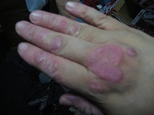 hand psoriasis before